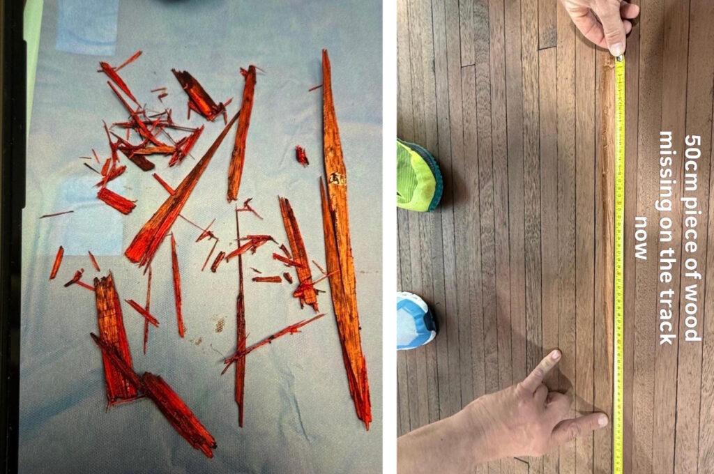 Деревянные осколки, вытащенные из тела Морица Мауса